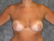Breast Reduction After Photo by Ronald Lohner, MD; Bryn Mawr, PA - Case 9062