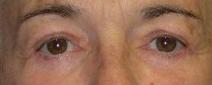 Eyelid Surgery After Photo by Ronald Lohner, MD; Bryn Mawr, PA - Case 9064