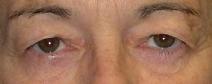 Eyelid Surgery Before Photo by Ronald Lohner, MD; Bryn Mawr, PA - Case 9064