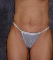 Tummy Tuck Before Photo by Ronald Lohner, MD; Bryn Mawr, PA - Case 9065