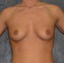 Breast Augmentation Before Photo by Ronald Lohner, MD; Bryn Mawr, PA - Case 9068