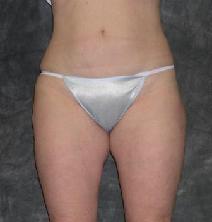 Liposuction Before Photo by Ronald Lohner, MD; Bryn Mawr, PA - Case 9113