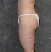 Liposuction After Photo by Ronald Lohner, MD; Bryn Mawr, PA - Case 9113