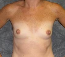 Breast Augmentation Before Photo by Ronald Lohner, MD; Bryn Mawr, PA - Case 9127