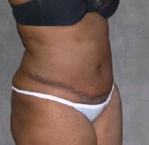 Tummy Tuck After Photo by Ronald Lohner, MD; Bryn Mawr, PA - Case 9264