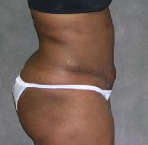 Tummy Tuck After Photo by Ronald Lohner, MD; Bryn Mawr, PA - Case 9264