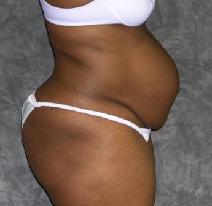 Tummy Tuck Before Photo by Ronald Lohner, MD; Bryn Mawr, PA - Case 9264