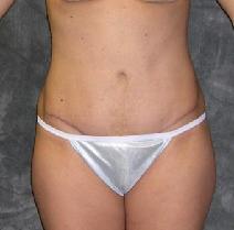 Tummy Tuck After Photo by Ronald Lohner, MD; Bryn Mawr, PA - Case 9300