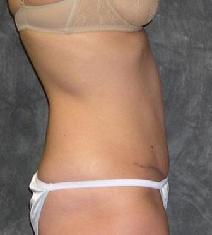 Tummy Tuck After Photo by Ronald Lohner, MD; Bryn Mawr, PA - Case 9300