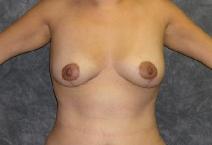 Breast Lift After Photo by Ronald Lohner, MD; Bryn Mawr, PA - Case 9439