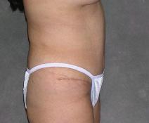 Tummy Tuck After Photo by Ronald Lohner, MD; Bryn Mawr, PA - Case 9452