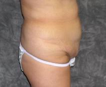 Tummy Tuck Before Photo by Ronald Lohner, MD; Bryn Mawr, PA - Case 9452
