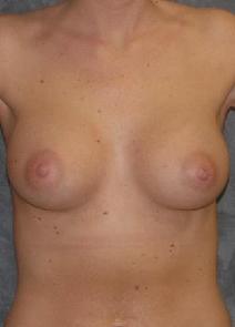 Breast Augmentation After Photo by Ronald Lohner, MD; Bryn Mawr, PA - Case 9891