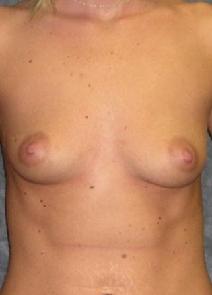 Breast Augmentation Before Photo by Ronald Lohner, MD; Bryn Mawr, PA - Case 9891