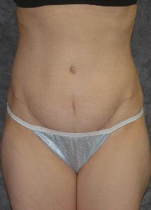 Tummy Tuck After Photo by Ronald Lohner, MD; Bryn Mawr, PA - Case 9892