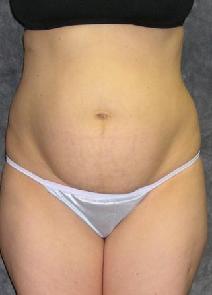 Tummy Tuck Before Photo by Ronald Lohner, MD; Bryn Mawr, PA - Case 9892