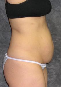 Tummy Tuck Before Photo by Ronald Lohner, MD; Bryn Mawr, PA - Case 9892