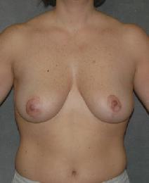 Breast Reduction After Photo by Ronald Lohner, MD; Bryn Mawr, PA - Case 9954