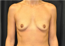 Breast Augmentation Before Photo by Andrew Smith, MD; Irvine, CA - Case 28054