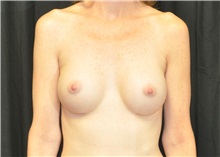 Breast Augmentation After Photo by Andrew Smith, MD; Irvine, CA - Case 28055