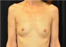 Breast Augmentation Before Photo by Andrew Smith, MD; Irvine, CA - Case 28055