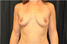 Breast Augmentation Before Photo by Andrew Smith, MD; Irvine, CA - Case 28056