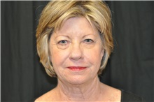 Facelift Before Photo by Andrew Smith, MD; Irvine, CA - Case 28690