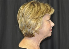 Facelift Before Photo by Andrew Smith, MD; Irvine, CA - Case 28690