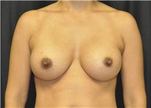 Breast Augmentation After Photo by Andrew Smith, MD; Irvine, CA - Case 28692