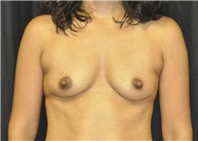 Breast Augmentation Before Photo by Andrew Smith, MD; Irvine, CA - Case 28692
