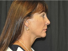 Facelift After Photo by Andrew Smith, MD; Irvine, CA - Case 28693