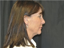 Facelift Before Photo by Andrew Smith, MD; Irvine, CA - Case 28693