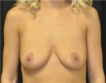 Breast Augmentation Before Photo by Andrew Smith, MD; Irvine, CA - Case 28716