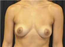 Breast Augmentation Before Photo by Andrew Smith, MD; Irvine, CA - Case 28718