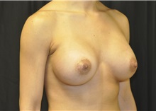 Breast Augmentation After Photo by Andrew Smith, MD; Irvine, CA - Case 28718