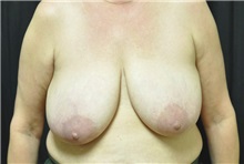 Breast Reconstruction Before Photo by Andrew Smith, MD; Irvine, CA - Case 28738