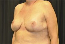 Breast Reconstruction After Photo by Andrew Smith, MD; Irvine, CA - Case 28738