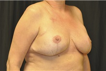 Breast Reconstruction After Photo by Andrew Smith, MD; Irvine, CA - Case 28738