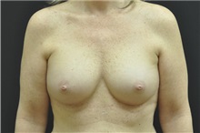 Breast Augmentation After Photo by Andrew Smith, MD; Irvine, CA - Case 28811