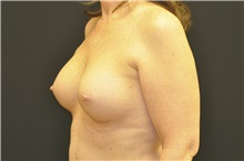 Breast Augmentation After Photo by Andrew Smith, MD; Irvine, CA - Case 28811
