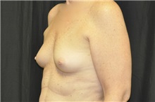 Breast Augmentation Before Photo by Andrew Smith, MD; Irvine, CA - Case 28811