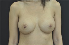 Breast Augmentation After Photo by Andrew Smith, MD; Irvine, CA - Case 28813