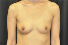 Breast Augmentation Before Photo by Andrew Smith, MD; Irvine, CA - Case 28813