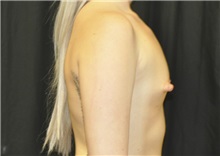 Breast Augmentation Before Photo by Andrew Smith, MD; Irvine, CA - Case 28869