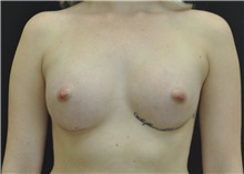 Breast Augmentation After Photo by Andrew Smith, MD; Irvine, CA - Case 28869