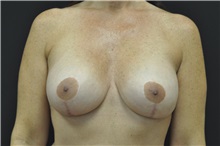 Breast Augmentation After Photo by Andrew Smith, MD; Irvine, CA - Case 28909
