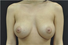 Breast Augmentation After Photo by Andrew Smith, MD; Irvine, CA - Case 28919
