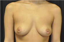 Breast Augmentation Before Photo by Andrew Smith, MD; Irvine, CA - Case 28919