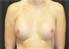 Breast Augmentation After Photo by Andrew Smith, MD; Irvine, CA - Case 28959