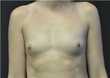 Breast Augmentation Before Photo by Andrew Smith, MD; Irvine, CA - Case 28959